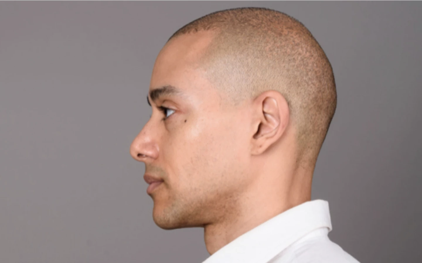 Baldness