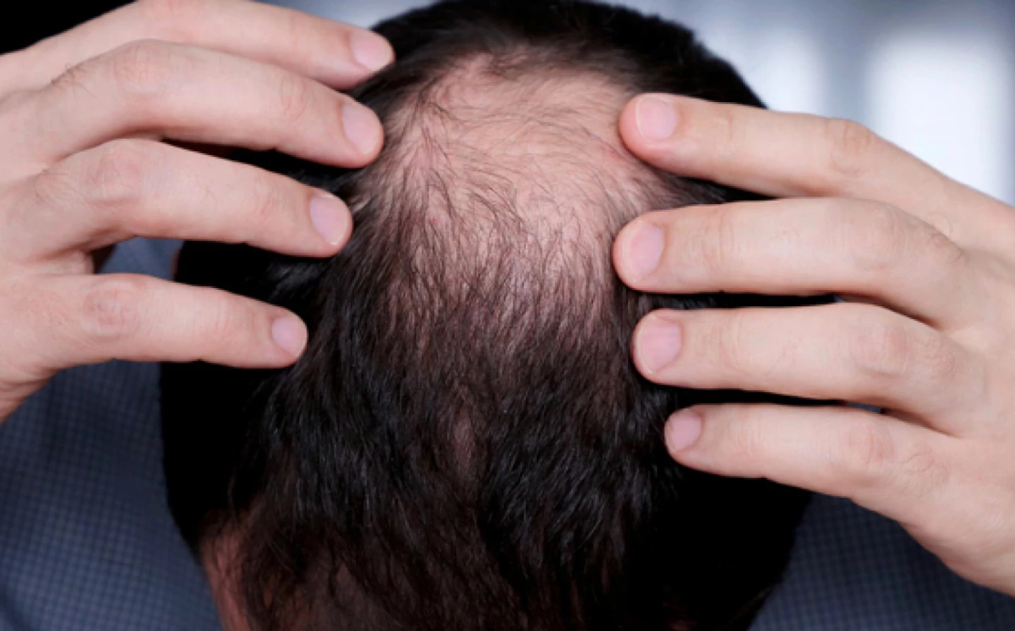 Thinning Hair