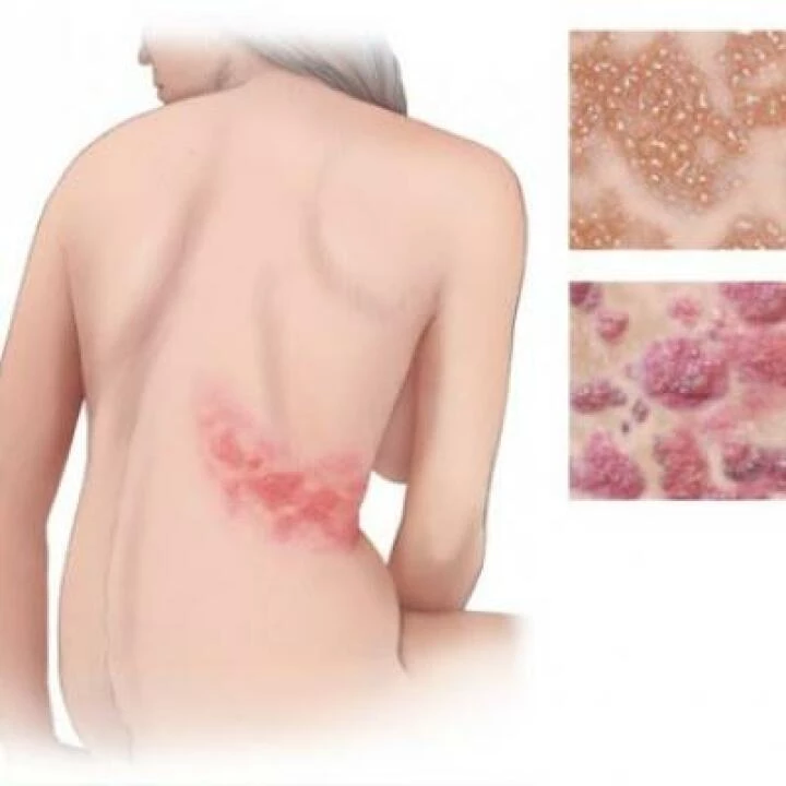 Shingles 02